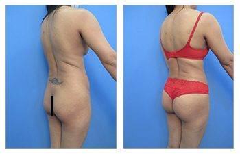 Difference between a butt lift and a butt tuck — patient photo Difference between a butt lift and a butt tuck — patient photo