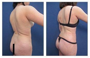 What is the World Association of Gluteal Surgeons? What is the World Association of Gluteal Surgeons?