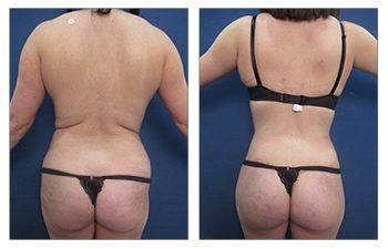 What is the World Association of Gluteal Surgeons? What is the World Association of Gluteal Surgeons?