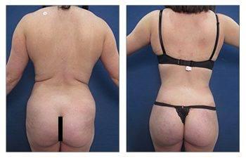 Before and after pictures of a woman with a large breast who underwent Liposuction. Before and after pictures of a woman with a large breast who underwent Liposuction.