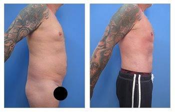 Before and after VASER Liposuction.
