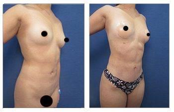 What Kind of Result will I Get After Mini Tummy Tuck What Kind of Result will I Get After Mini Tummy Tuck