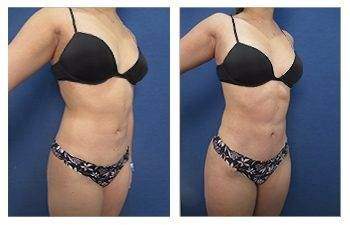 Tummy Tuck — #SS053 Tummy Tuck — #SS053