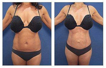 Mini Tummy Tuck + Lipo Revision — #SS058 Mini Tummy Tuck + Lipo Revision — #SS058