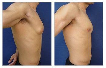 A poster for the 10th anniversary of brows and liposuction in Pasadena, Los Angeles.