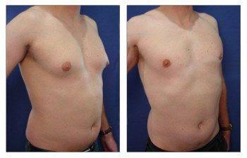 edited gynecomastia-patient-12-front-right edited gynecomastia-patient-12-front-right