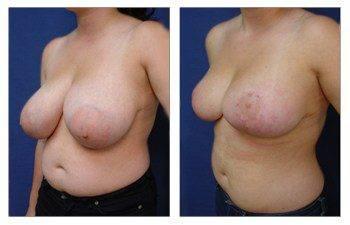 When Do Breast Lift Scars Fade, CPSI, width: 350px; height: 225px;