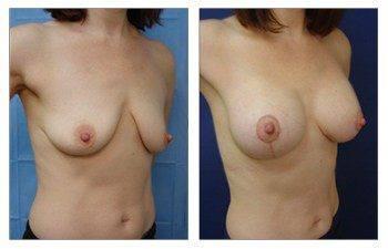 When Is A Breast Lift Covered By Insurance, CPSI, width: 350px; height: 225px; When Is A Breast Lift Covered By Insurance, CPSI, width: 350px; height: 225px;