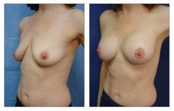 When Is A Breast Lift Covered By Insurance, CPSI, width: 350px; height: 225px; When Is A Breast Lift Covered By Insurance, CPSI, width: 350px; height: 225px;