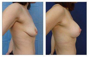 When Is A Breast Lift Covered By Insurance, CPSI. When Is A Breast Lift Covered By Insurance, CPSI.