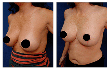 A woman's breasts before and after breast surgery with HD Liposuction.