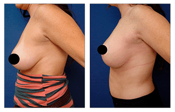 A woman's breast before and after HD Liposuction surgery.