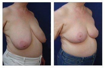 Where Are Breast Lift Scars, CPSI, width: 350px; height: 225px;