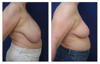 Where Are Breast Lift Scars, CPSI, width: 350px; height: 225px;
