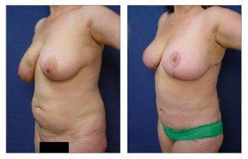 Which breast lift do I need, CPSI, width: 350px; height: 225px; Which breast lift do I need, CPSI, width: 350px; height: 225px;