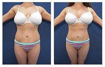 Mini Tummy Tuck — #SS075 Mini Tummy Tuck — #SS075