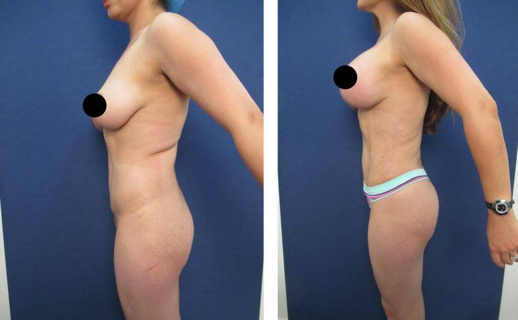 Who Qualifies for Mini Tummy Tuck