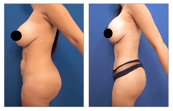 Why BBL Revision Cannot be Performed After Laser Liposuction Why BBL Revision Cannot be Performed After Laser Liposuction
