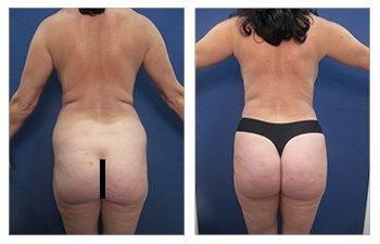 Why is VASER liposuction ideal for BBL Why is VASER liposuction ideal for BBL