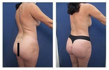 Why is VASER liposuction ideal for BBL Why is VASER liposuction ideal for BBL