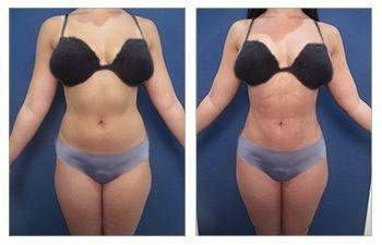 Why Renuvion scarless skin tightening is the ideal supplement to VASER high definition liposuction? Why Renuvion scarless skin tightening is the ideal supplement to VASER high definition liposuction?