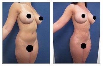 Renuvion scarless skin tightening Renuvion scarless skin tightening