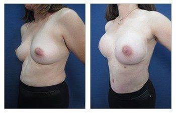 Breast Lift Surgery Breast Lift Surgery