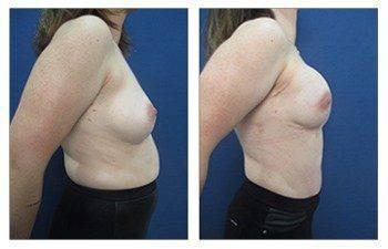 The transformation of a woman's breast before and after surgery for breast reconstruction. The transformation of a woman's breast before and after surgery for breast reconstruction.
