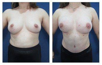A woman's breast before and after breast reconstruction surgery. A woman's breast before and after breast reconstruction surgery.