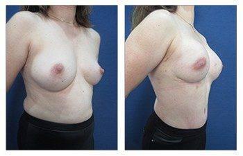 A woman's breast before and after surgery to undergo breast reconstruction. A woman's breast before and after surgery to undergo breast reconstruction.