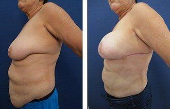 breasts can look better than they look before undergoing the journey of having breast cancer