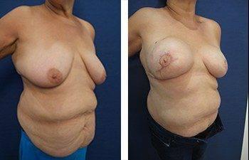 breasts can look better than they look before undergoing the journey of having breast cancer