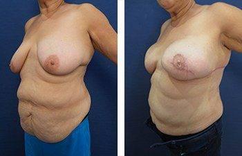 breasts can look better than they look before undergoing the journey of having breast cancer