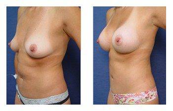 Breast Augmentation Newport Beach, CPSI.