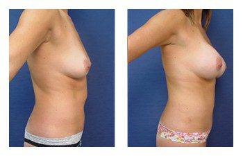 Breast Augmentation Newport Beach, CPSI.