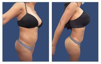 Body Contouring corrects specific areas of body concern