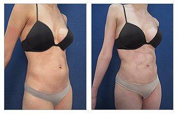 Abdominal Etching 35 - Liposuction Risks