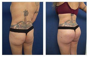 Round vs Oval Buttock Implants
