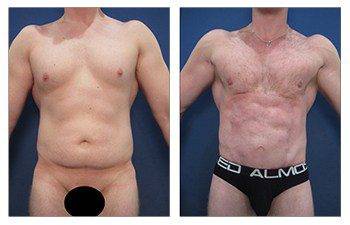 liposuction laser