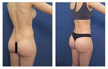 brazilian buttock lift surgery back right view