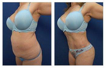 Best Liposuction