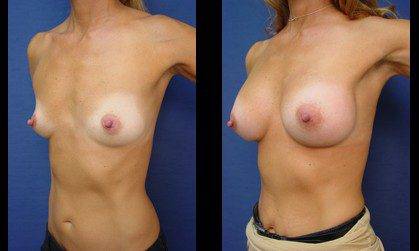 Breast Augmentation Orange County