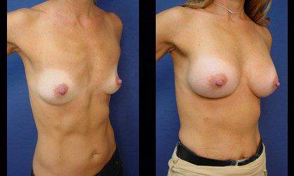 Breast Augmentation Beverly Hills
