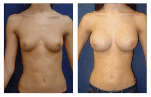 Breast Augmentation Recovery