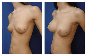 Breast Augmentation Recovery