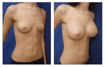 Breast Implant Los Angeles