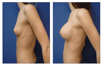 Breast Augmentation Newport Beach