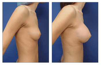 Breast Implant Beverly Hills