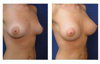 Breast Augmentation Surgery Price, CPSI.