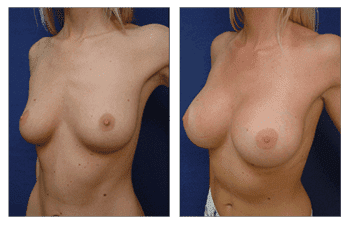 Breast enhancement procedure